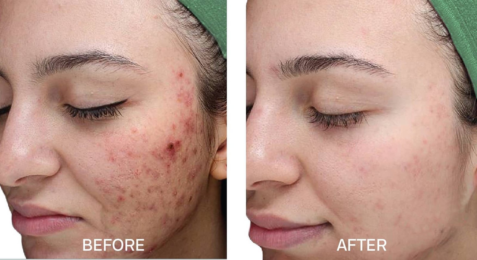Glycolic-peel-before-and-after-6